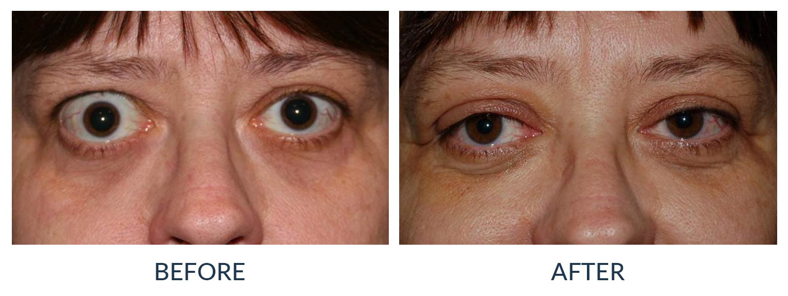 Lower Lid Retraction Vermont Cosmetic Eye